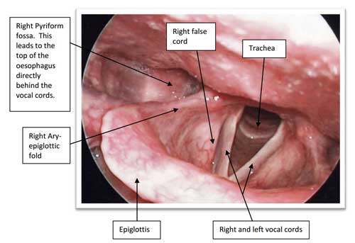 normal larynx examination