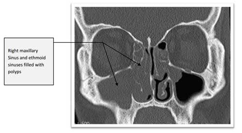 Nasal polyps on CT scan