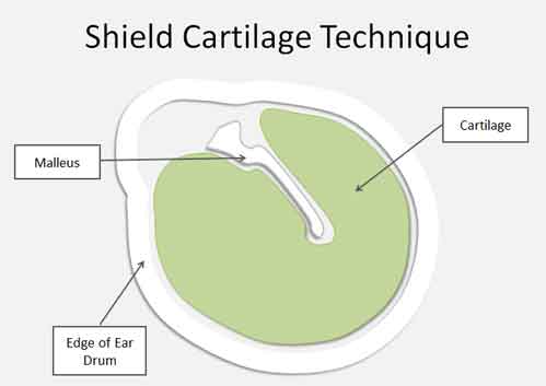 tympanic perforation shield cartilage tympanoplasty repair