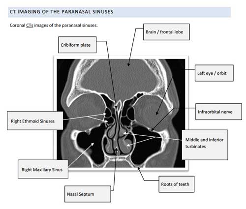 CT of normal sinuses