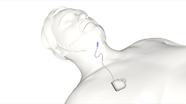 An Inspire implant working