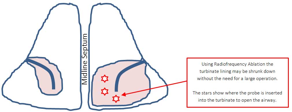 enlarged turbinates