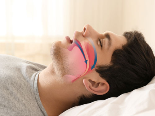 A diagram showing the flow of air when a person is snoring.