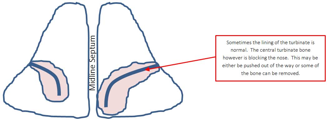enlarged turbinates