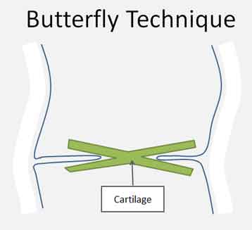 tympanic-perforation