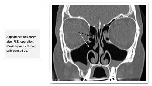 CT after removal of polyps
