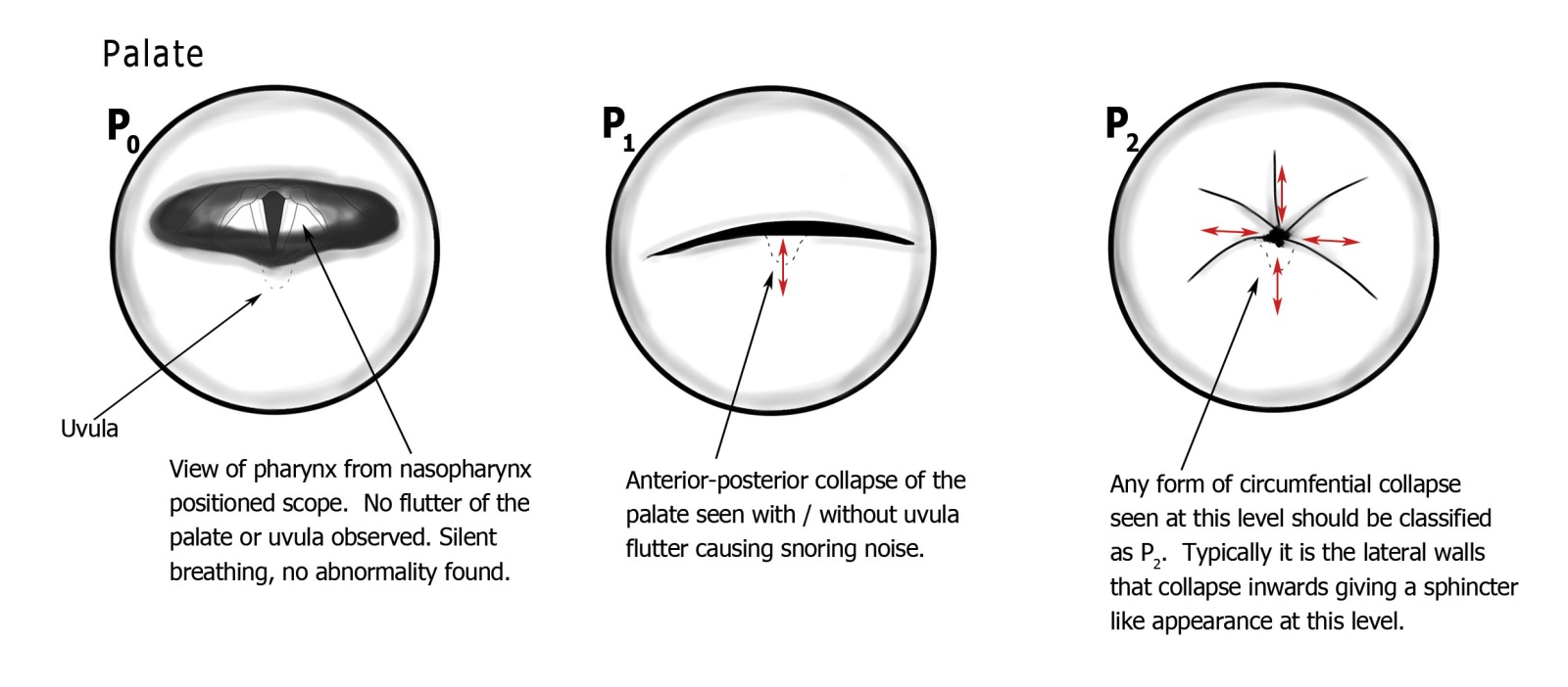 PTLTbE classification — P (Palate) level: P0 normal, P1 anteroposterior collapse, P2 circumferential collapse