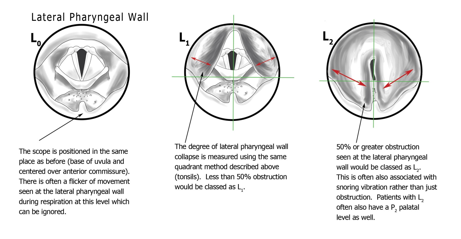PTLTbE classification — L (Lateral pharyngeal wall) level: L0 normal, L1 less than 50% collapse, L2 50% or more collapse