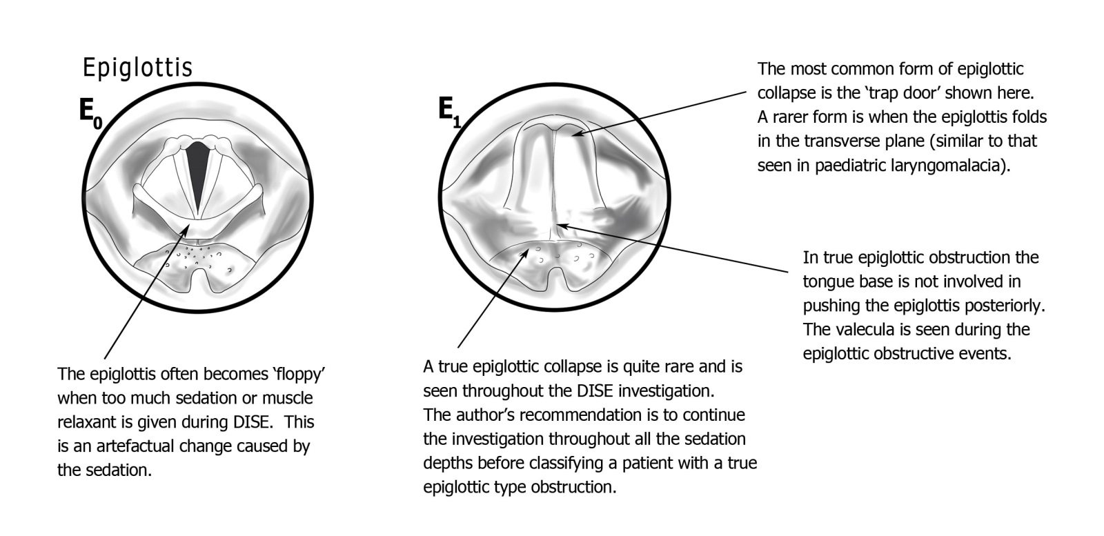 PTLTbE classification — E (Epiglottis) level: E0 normal, E1 epiglottic obstruction (trapdoor, omega, or laryngomalacic pattern)