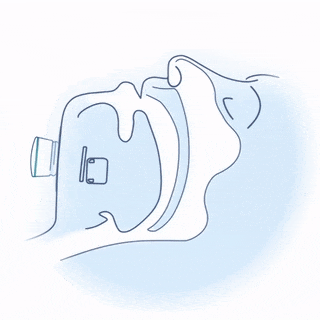 A Nyxoah genio implant working