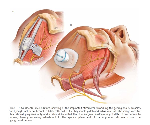 A Nyxoah genio implant and battery surgery view