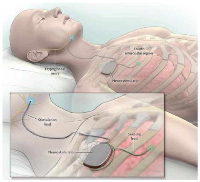 An Inspire implant and remote control