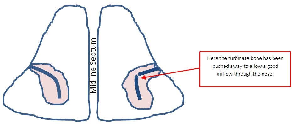 outfracture turbinates