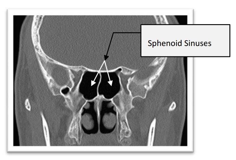CT of sphenoid sinus