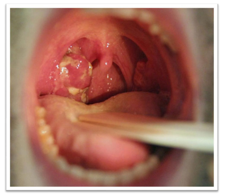 cover of book about tonsillectomy