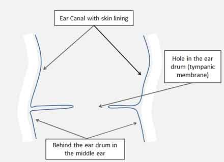 tympanic-perforation