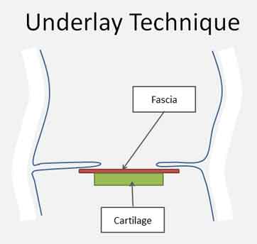tympanic-perforation