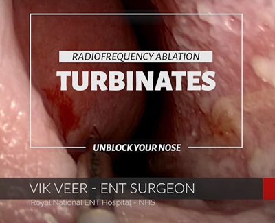 Prof Vik Veer discusses how to treat turbinates with celon radiofrequency frequency Ablation
