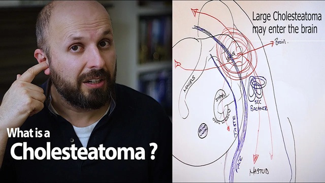 Dr Vik Veer discusses how to treat cholesteatoma