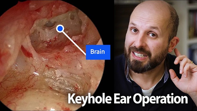 Dr Vik Veer discusses how to treat cholesteatoma with mastoidectomy