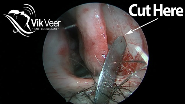 Prof Vik Veer discusses how to do a septoplasty operation